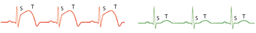 ECG Hartinfarct