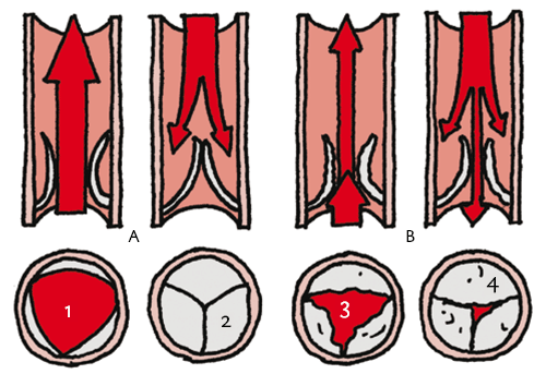 Aortaklepstenose