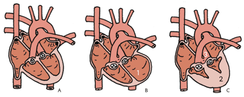 Cardiomyopathie