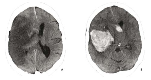 Beroerte (CVA)