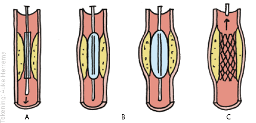 Dotteren