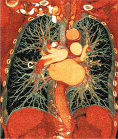 Longembolie CT-scan