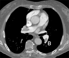 Longembolie CT-scan