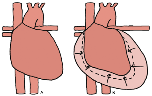 Pericarditis